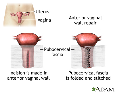 Anterior vaginal wall repair