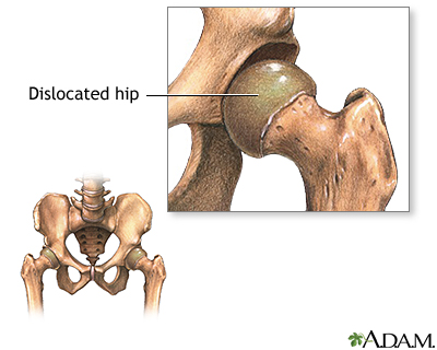 Congential hip dislocation