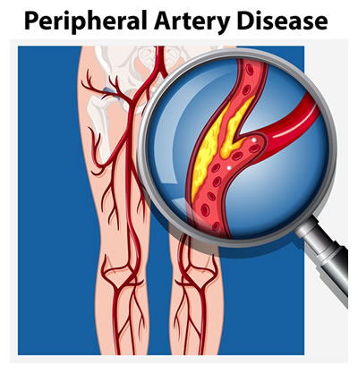 Peripheral artery disease in legs illustration