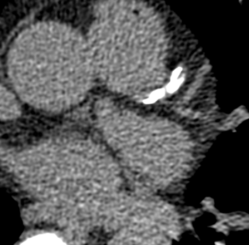 Coronary artery with severe calcium build up