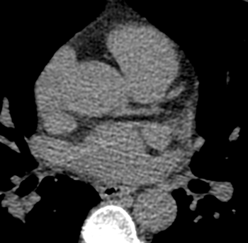 Coronary artery without calcium build up