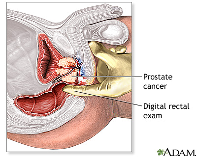 Prosztata adenoma lézeres resection műtét