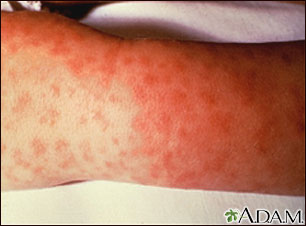 Rocky mountain spotted fever, lesions on arm