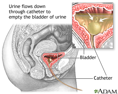 Bladder catheterization, female