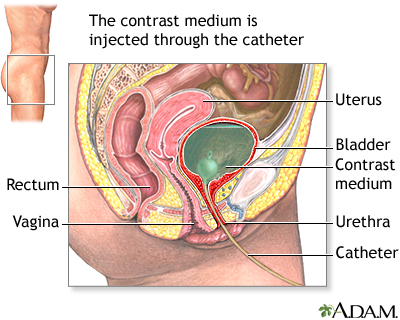 Voiding cystourethrogram