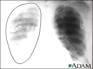 Aortic rupture, chest X-ray
