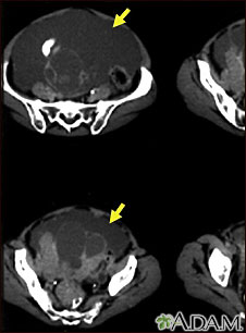 Ascites with ovarian cancer, CT scan