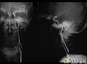 Carotid stenosis, X-ray of the left artery