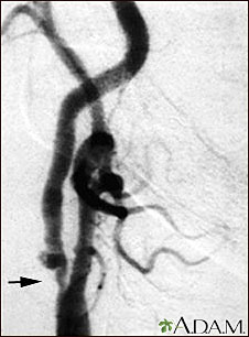 Carotid stenosis, X-ray of the right artery