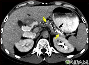 Pancreatitis, chronic - CT scan