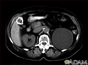 Kidney cyst with gallstones, CT scan