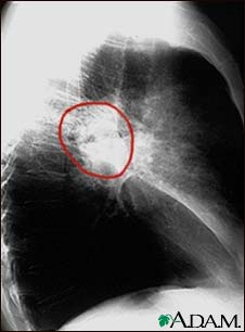 Lung cancer, lateral chest X-ray