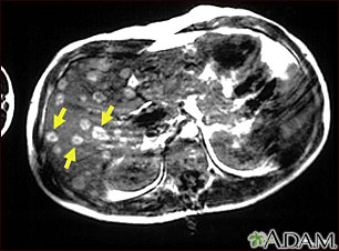 Melanoma of the liver - MRI scan