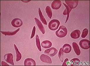 Red blood cells, multiple sickle cells