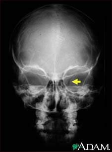 Neurofibromatosis I, enlarged optic foramen