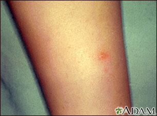 Chickenpox - lesion on the leg