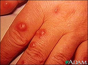 Cryptococcus, cutaneous on the hand