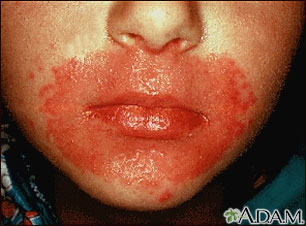 Candidiasis, cutaneous - around the mouth