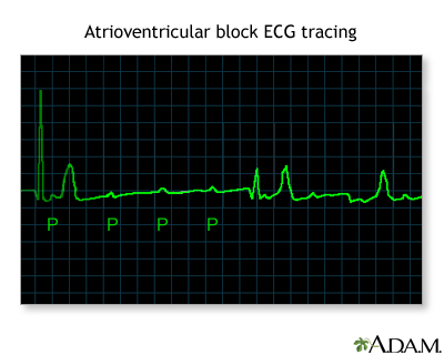 Atrioventricular block, ECG tracing