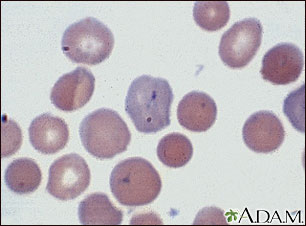 Malaria, microscopic view of cellular parasites
