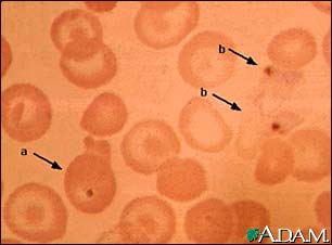 Malaria, photomicrograph of cellular parasites