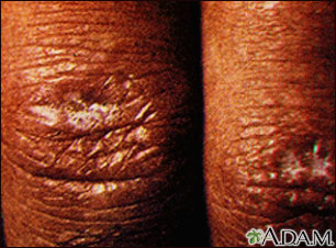 Dermatomyositis, Gottron's papule