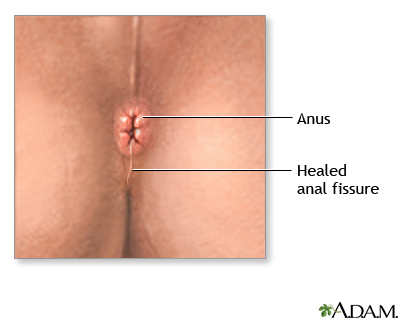 Fissure treatment an anal fissure or fissure