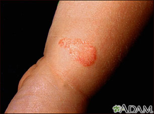 Ringworm, tinea corporis on an infant's leg