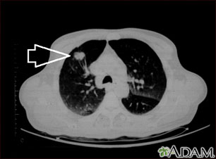 Lung mass, right upper lobe - CT scan