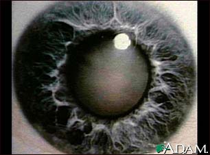 Cataract - close-up of the eye