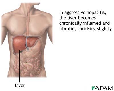 Aggressive hepatitis