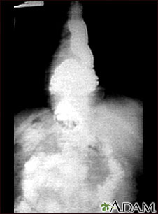 Hiatal hernia - X-ray