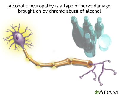 Alcoholic neuropathy