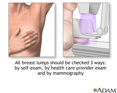 Breast lumps