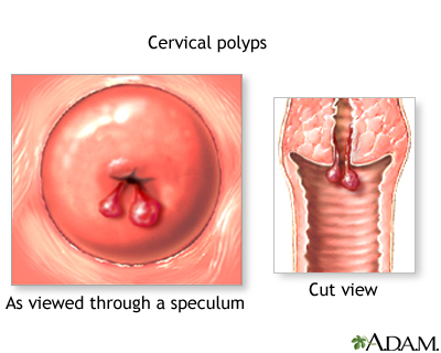 Cervical polyps
