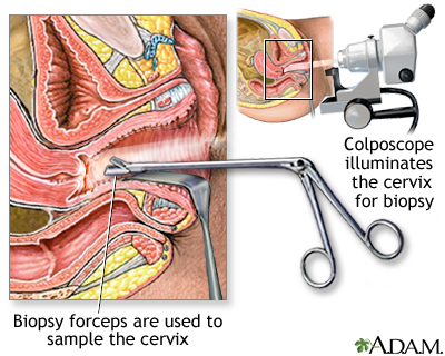 Colposcopy-directed biopsy