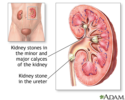 Kidney stones | Multimedia Encyclopedia | Health Information | St. Luke's  Hospital