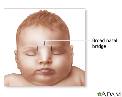 Broad nasal bridge