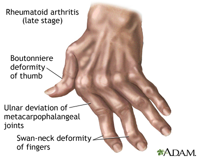a csukló rheumatoid arthritise)