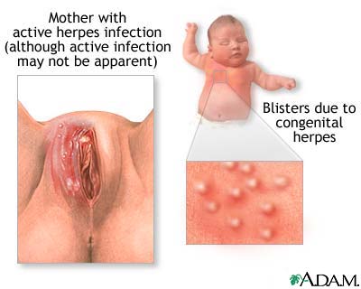 Congenital herpes
