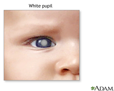 White spots in the pupil