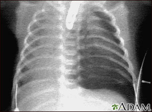 Pneumothorax - chest X-ray