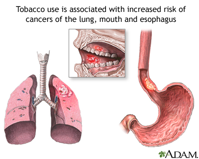 Tobacco and cancer