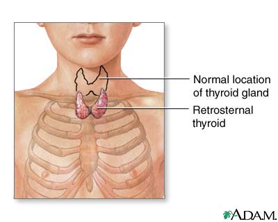 Retrosternal thyroid