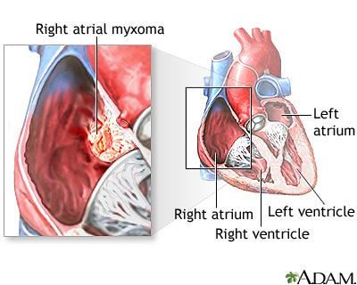 Right atrial myxoma