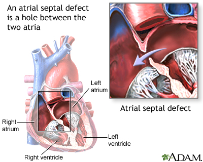 Atrial septal defect (ASD) | Multimedia Encyclopedia | Health Information |  St. Luke's Hospital