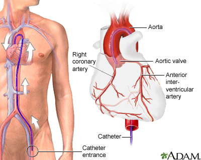 Coronary angiography | Multimedia Encyclopedia | Health Information | St.  Luke's Hospital