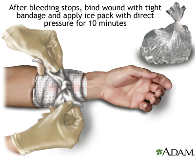 Stopping bleeding with pressure and ice