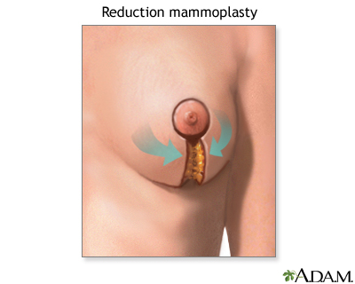 Breast augmentation surgery, Multimedia Encyclopedia, Health Information