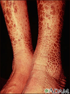 Ichthyosis, acquired - legs